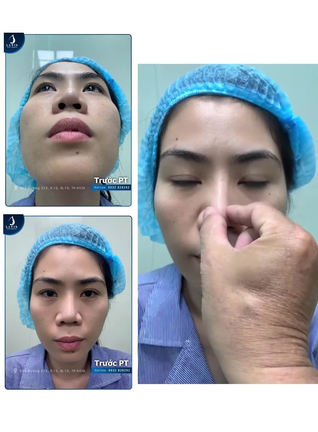 Xử lý thành công ca sửa mũi cho chị gái từ Singapo về Việt Nam làm đẹp